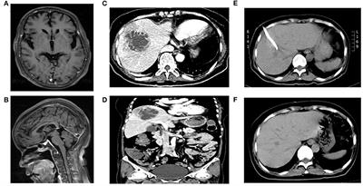 Case Report: Diagnosis of Klebsiella pneumoniae Invasive Liver Abscess Syndrome With Purulent Meningitis in a Patient From Pathogen to Lesions